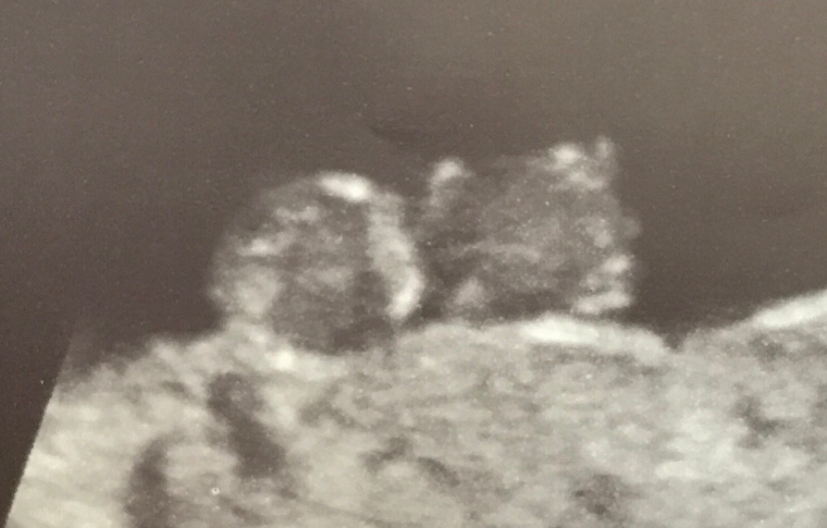 An ultrasound image of Mary Rose McAdam